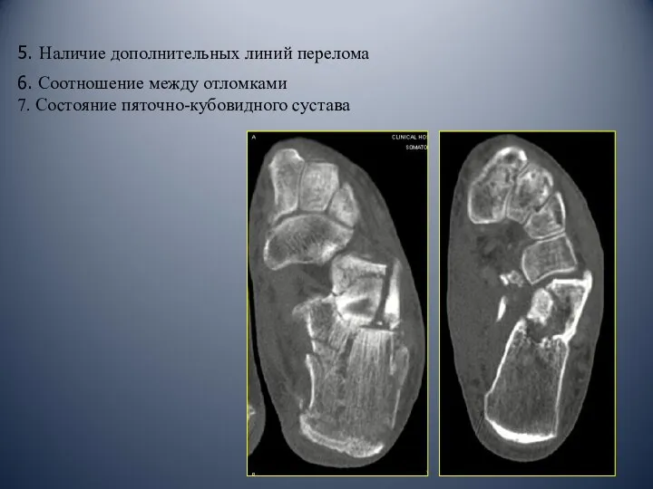 5. Наличие дополнительных линий перелома 6. Соотношение между отломками 7. Состояние пяточно-кубовидного сустава