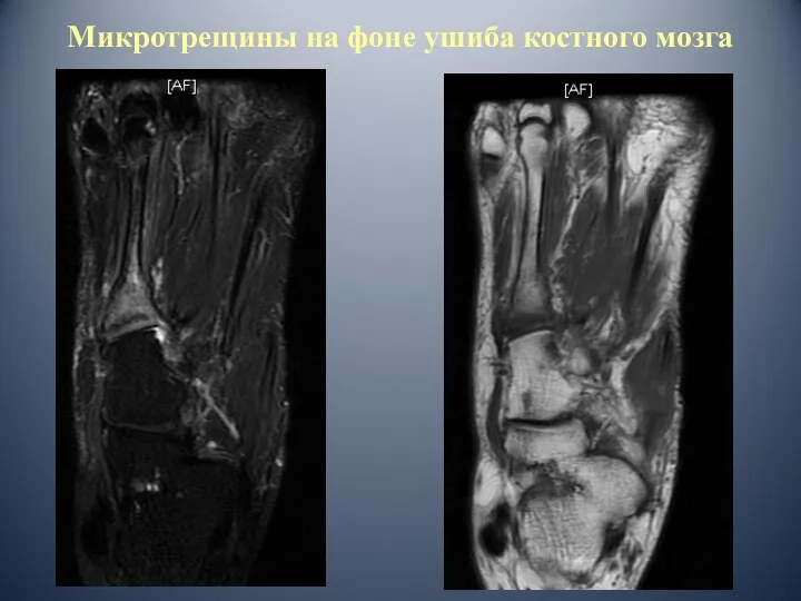 Микротрещины на фоне ушиба костного мозга