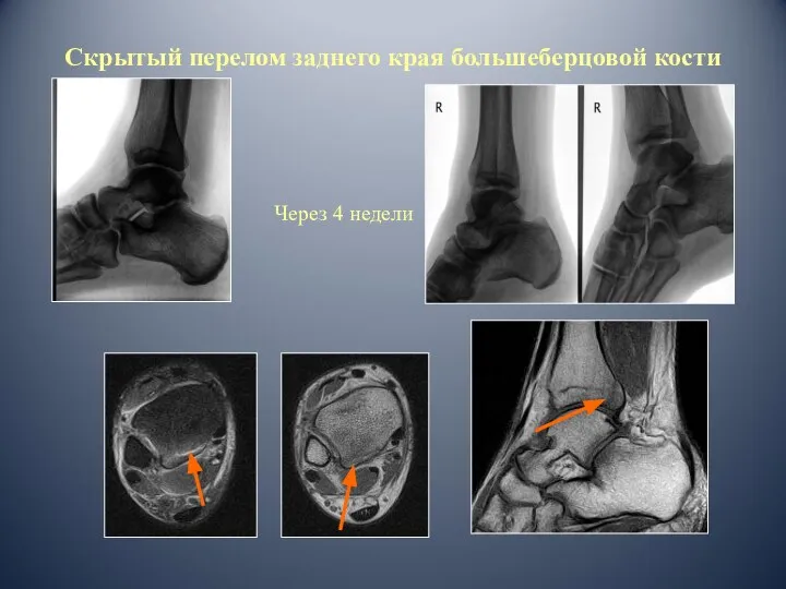 Скрытый перелом заднего края большеберцовой кости Через 4 недели