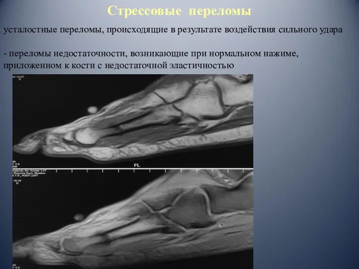 Стрессовые переломы усталостные переломы, происходящие в результате воздействия сильного удара -