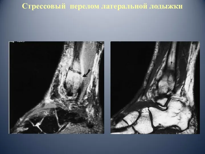 Стрессовый перелом латеральной лодыжки