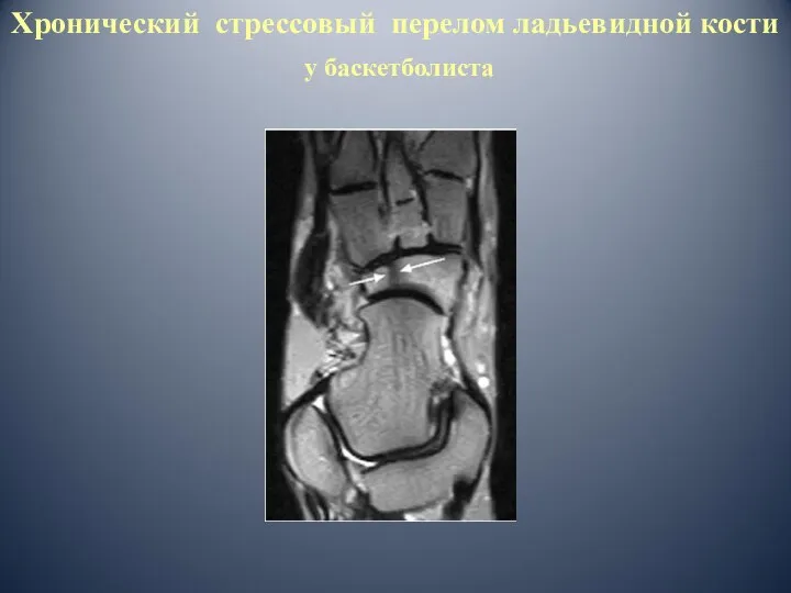 Хронический стрессовый перелом ладьевидной кости у баскетболиста