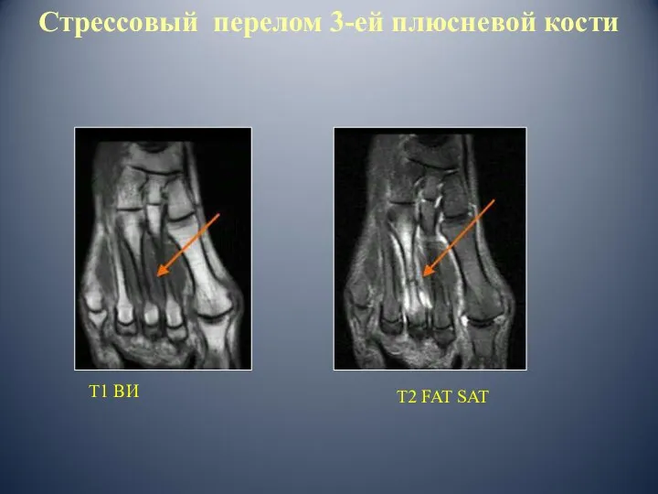 Т1 ВИ Т2 FAT SAT Стрессовый перелом 3-ей плюсневой кости