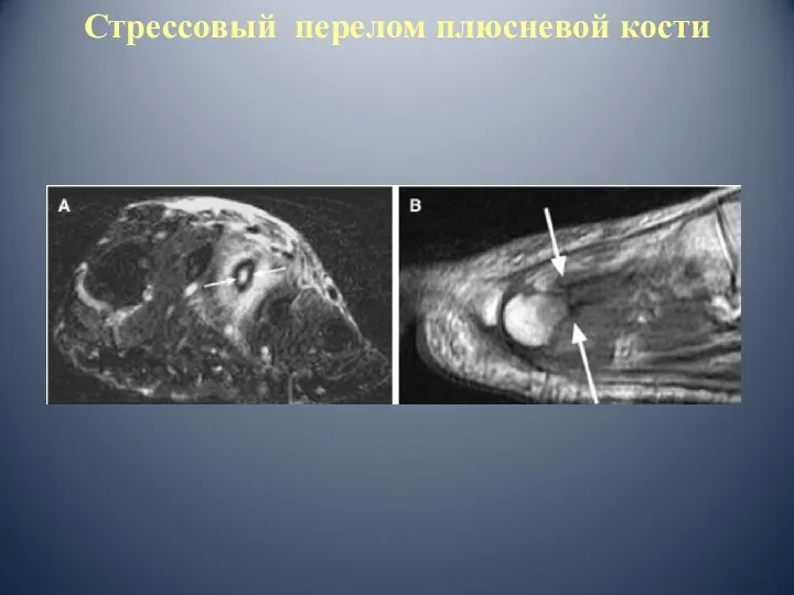 Стрессовый перелом плюсневой кости