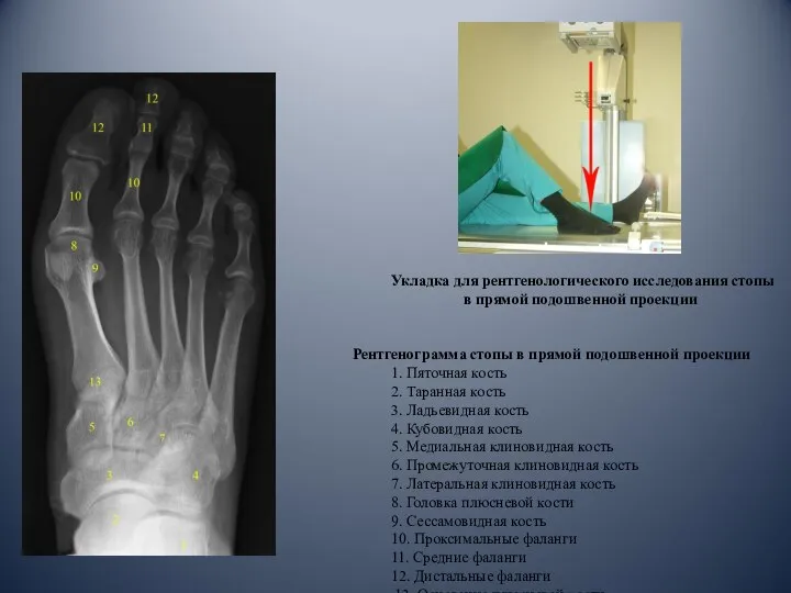 Укладка для рентгенологического исследования стопы в прямой подошвенной проекции Рентгенограмма стопы