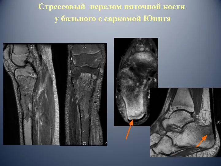 Стрессовый перелом пяточной кости у больного с саркомой Юинга