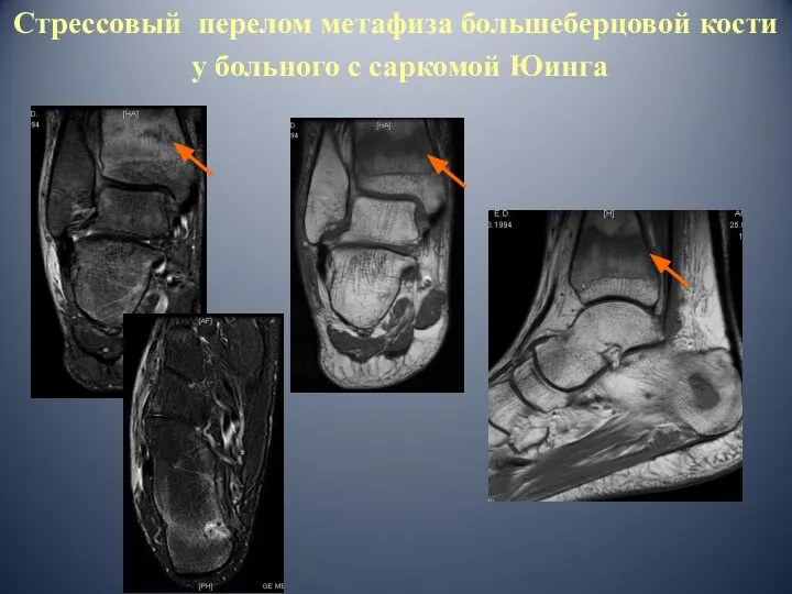 Стрессовый перелом метафиза большеберцовой кости у больного с саркомой Юинга