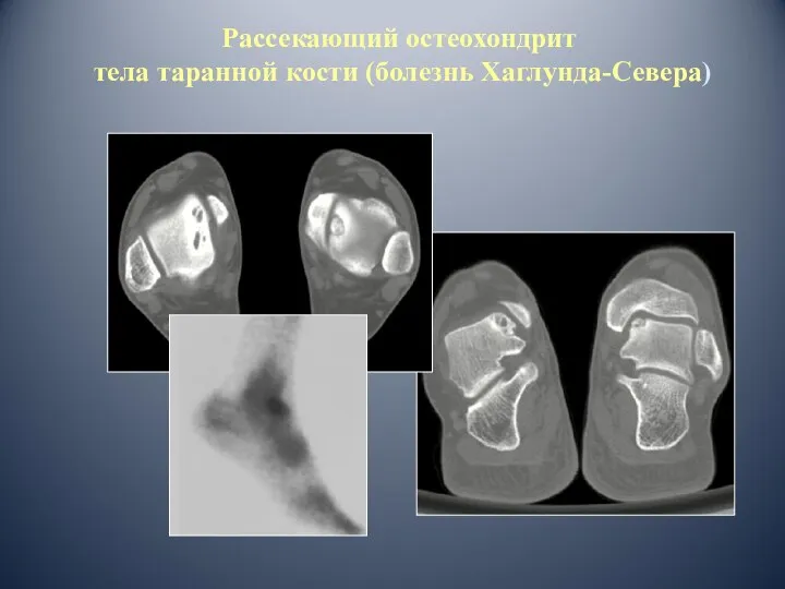 Рассекающий остеохондрит тела таранной кости (болезнь Хаглунда-Севера)