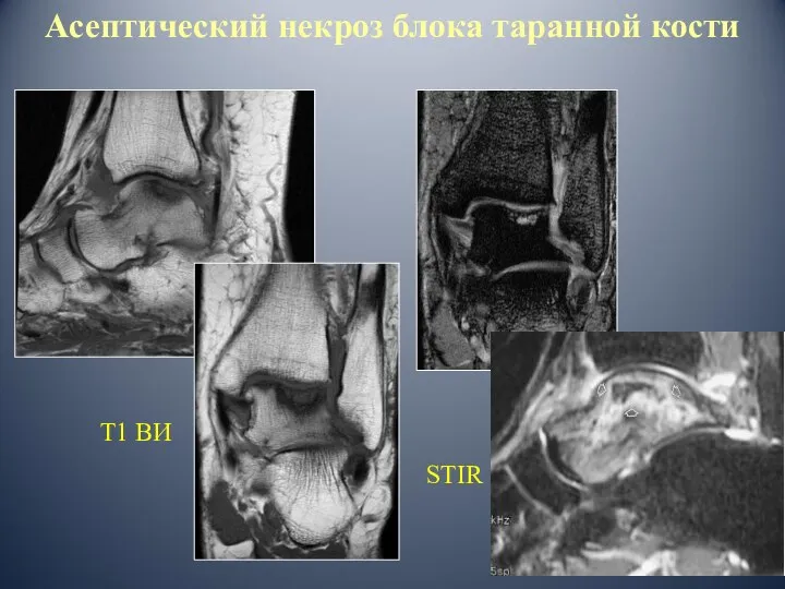 Т1 ВИ STIR Асептический некроз блока таранной кости