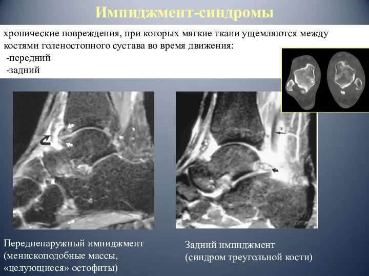 хронические повреждения, при которых мягкие ткани ущемляются между костями голеностопного сустава