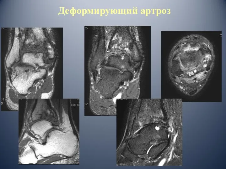 Деформирующий артроз