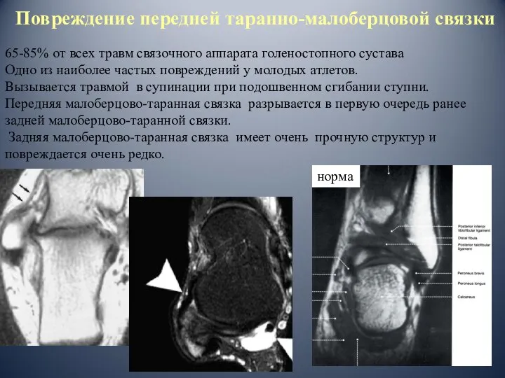 Повреждение передней таранно-малоберцовой связки 65-85% от всех травм связочного аппарата голеностопного