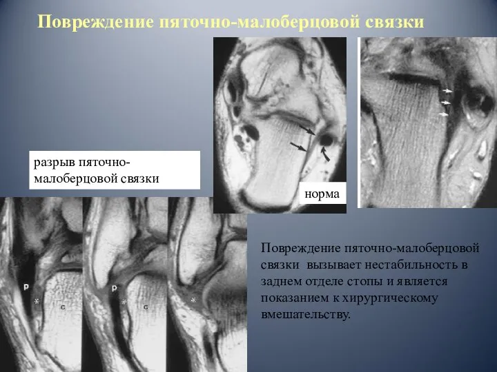 разрыв пяточно-малоберцовой связки Повреждение пяточно-малоберцовой связки норма Повреждение пяточно-малоберцовой связки вызывает