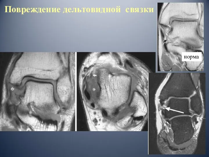 Повреждение дельтовидной связки норма