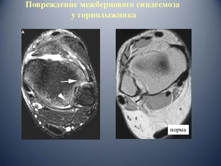 Повреждение межберцового синдесмоза у горнолыжника норма