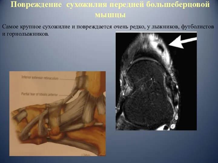 Повреждение сухожилия передней большеберцовой мышцы Самое крупное сухожилие и повреждается очень