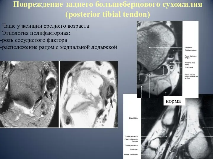 Повреждение заднего большеберцового сухожилия (posterior tibial tendon) Чаще у женщин среднего