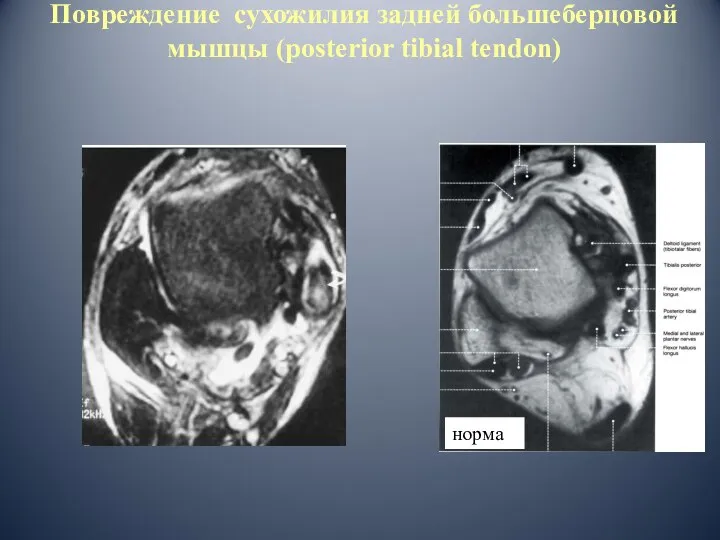 Повреждение сухожилия задней большеберцовой мышцы (posterior tibial tendon) норма