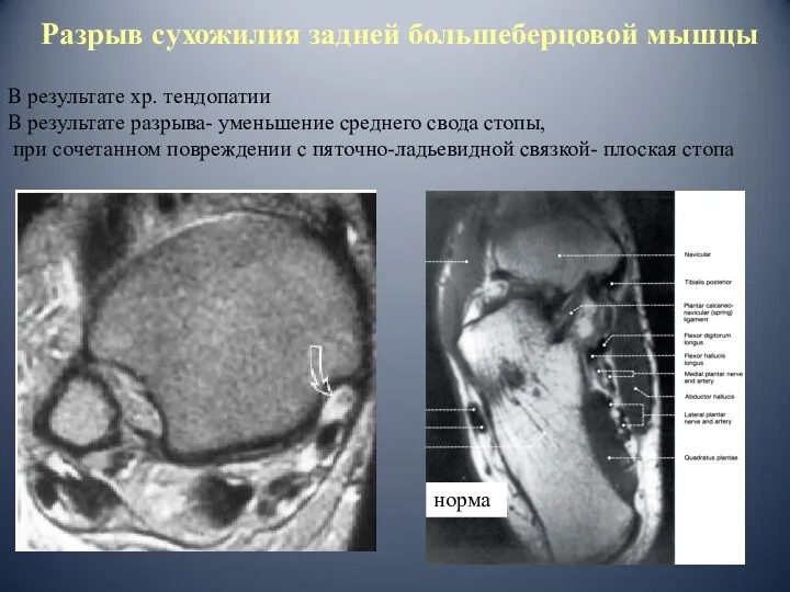 Разрыв сухожилия задней большеберцовой мышцы В результате хр. тендопатии В результате