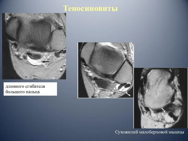 длинного сгибателя большого пальца Теносиновиты Сухожилий малоберцовой мышцы