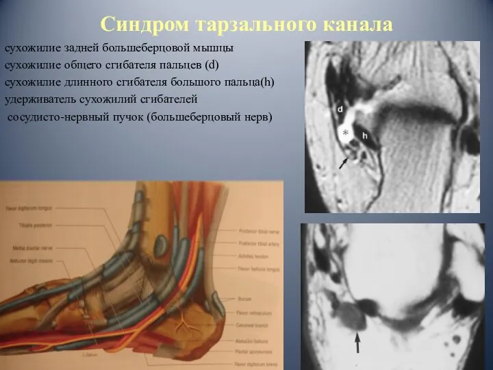 Синдром тарзального канала сухожилие задней большеберцовой мышцы сухожилие общего сгибателя пальцев