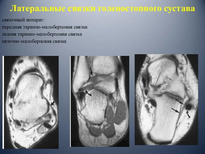 Латеральные связки голеностопного сустава связочный аппарат: передняя таранно-малоберцовая связка задняя таранно-малоберцовая связка пяточно-малоберцовая связка