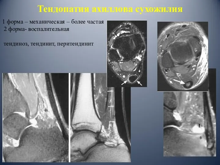 Тендопатия ахиллова сухожилия 1 форма – механическая – более частая 2 форма- воспалительная тендиноз, тендинит, перитендинит