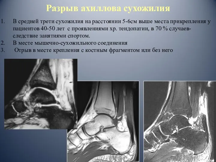 Разрыв ахиллова сухожилия В средней трети сухожилия на расстоянии 5-6см выше