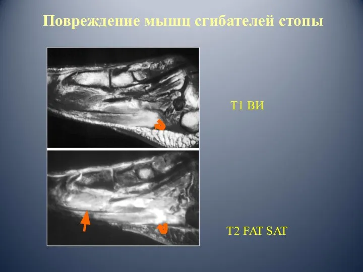 Повреждение мышц сгибателей стопы Т2 FAT SAT Т1 ВИ