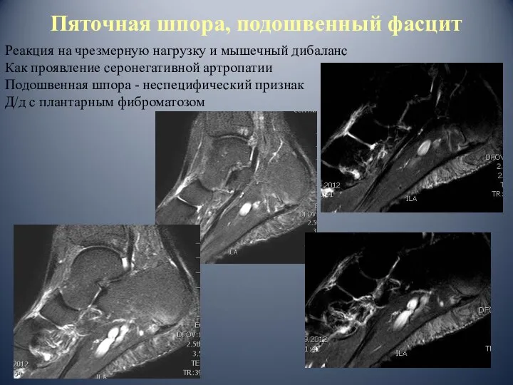 Пяточная шпора, подошвенный фасцит Реакция на чрезмерную нагрузку и мышечный дибаланс