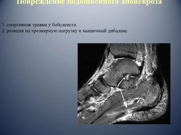 Повреждение подошвенного апоневроза 1. спортивная травма у бобслеиста 2. реакция на чрезмерную нагрузку и мышечный дибаланс