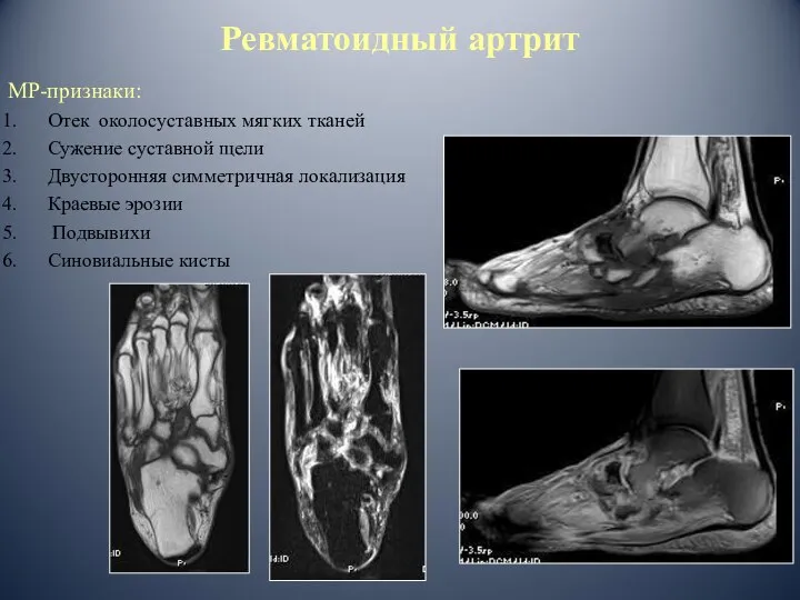 Ревматоидный артрит МР-признаки: Отек околосуставных мягких тканей Сужение суставной щели Двусторонняя