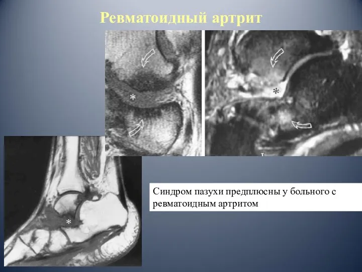 Синдром пазухи предплюсны у больного с ревматоидным артритом Ревматоидный артрит