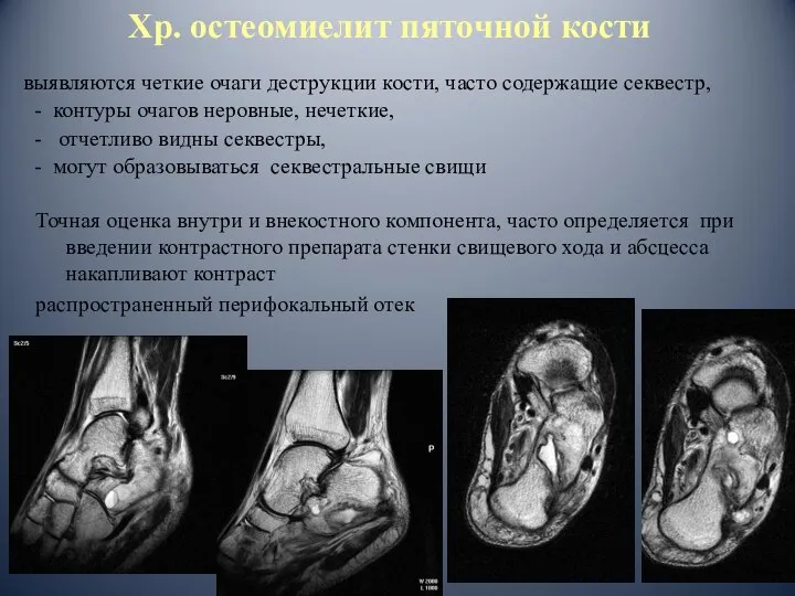 Хр. остеомиелит пяточной кости Точная оценка внутри и внекостного компонента, часто