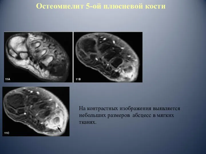 Остеомиелит 5-ой плюсневой кости На контрастных изображения выявляется небольших размеров абсцесс в мягких тканях.