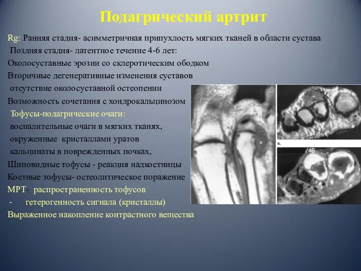 Подагрический артрит Rg: Ранняя стадия- асимметричная припухлость мягких тканей в области