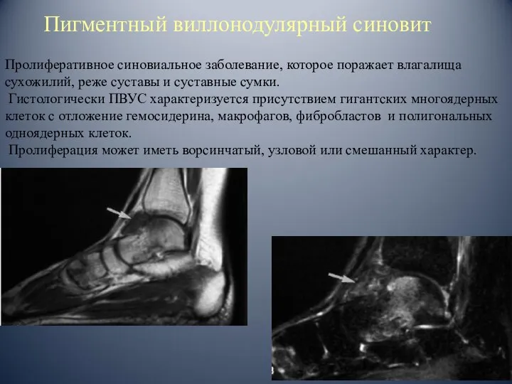 Пигментный виллонодулярный синовит Пролиферативное синовиальное заболевание, которое поражает влагалища сухожилий, реже