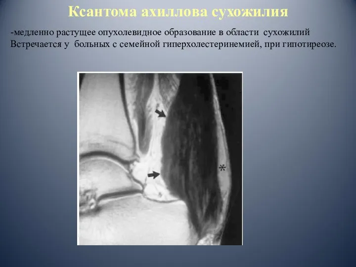 Ксантома ахиллова сухожилия -медленно растущее опухолевидное образование в области сухожилий Встречается