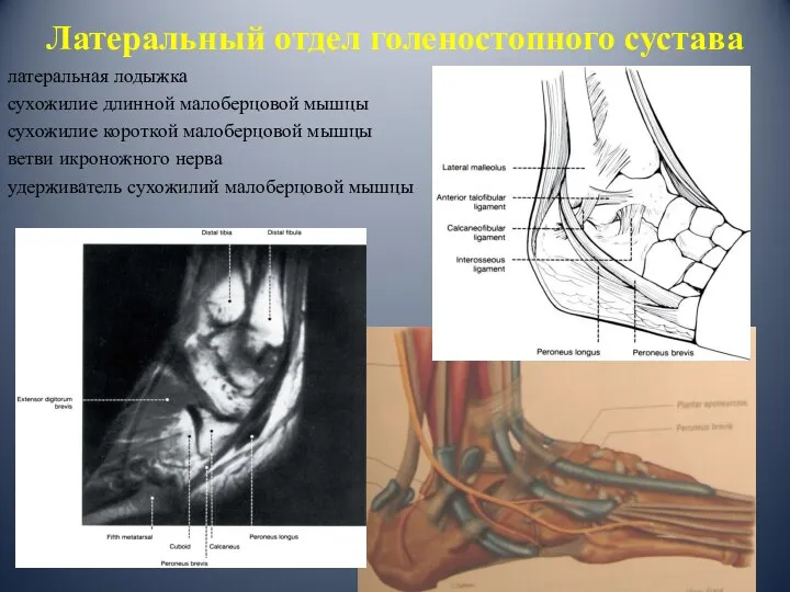 Латеральный отдел голеностопного сустава латеральная лодыжка сухожилие длинной малоберцовой мышцы сухожилие