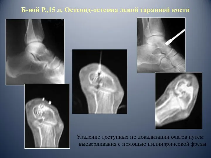 Б-ной Р.,15 л. Остеоид-остеома левой таранной кости Удаление доступных по локализации