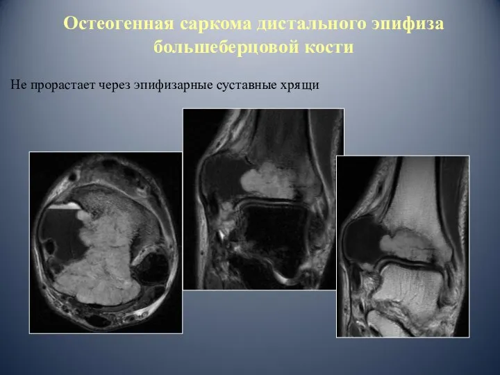 Остеогенная саркома дистального эпифиза большеберцовой кости Не прорастает через эпифизарные суставные хрящи