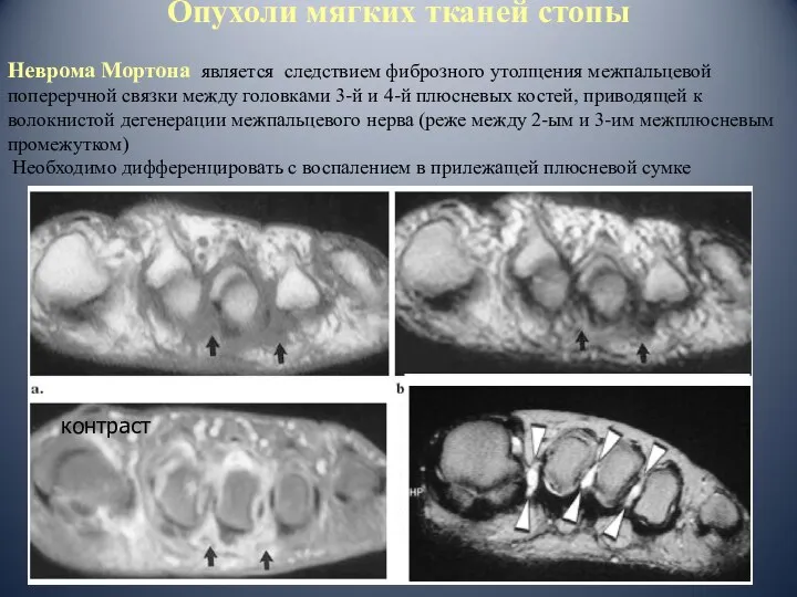 Опухоли мягких тканей стопы Неврома Мортона является следствием фиброзного утолщения межпальцевой