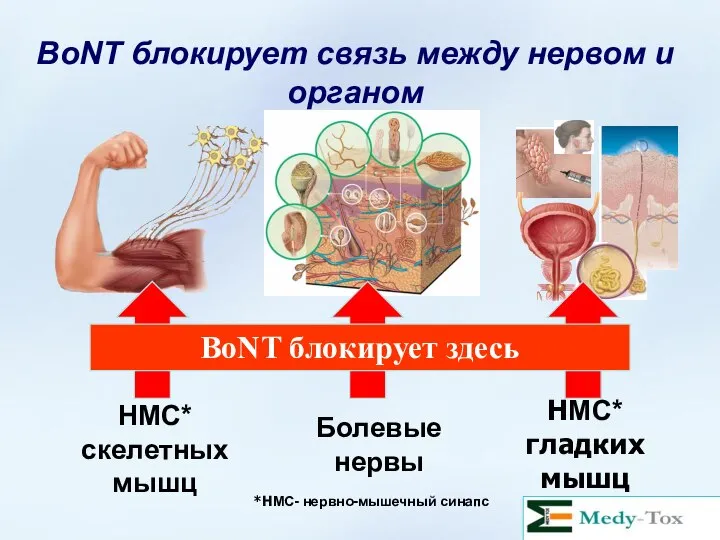 НМС* скелетных мышц Болевые нервы НМС* гладких мышц BoNT блокирует связь