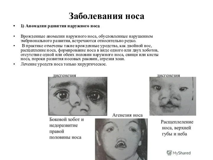 Заболевания носа 1) Аномалии развития наружного носа Врожденные аномалии наружного носа,