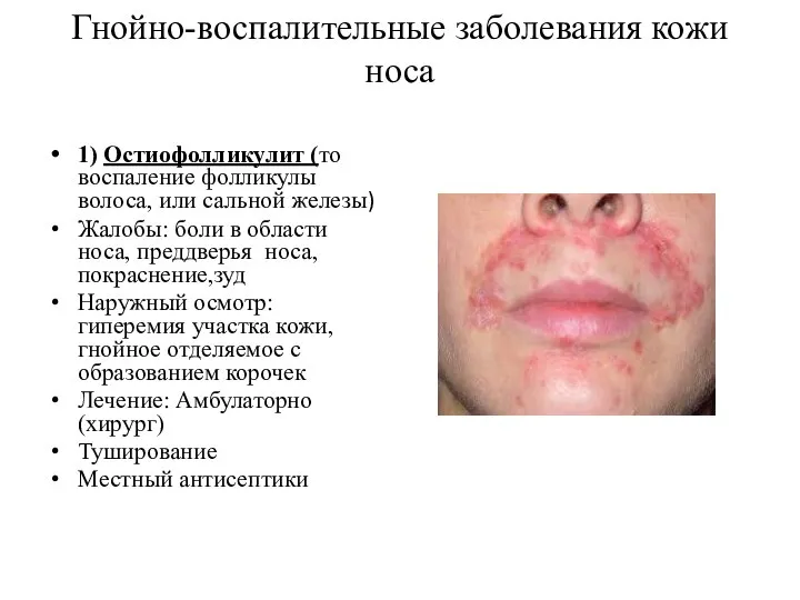 Гнойно-воспалительные заболевания кожи носа 1) Остиофолликулит (то воспаление фолликулы волоса, или