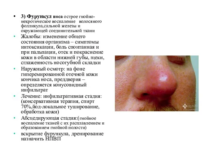 3) Фурункул носа острое гнойно-некротическое воспаление волосяного фолликула,сальной железы и окружающей