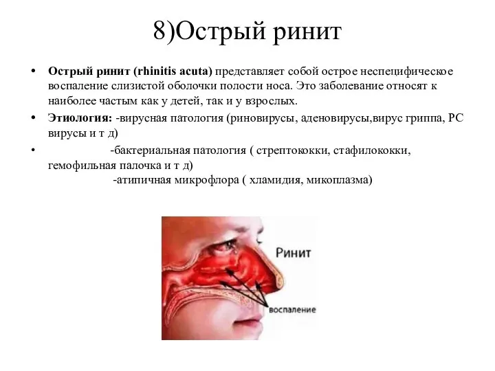 8)Острый ринит Острый ринит (rhinitis acuta) представляет собой острое неспецифическое воспаление