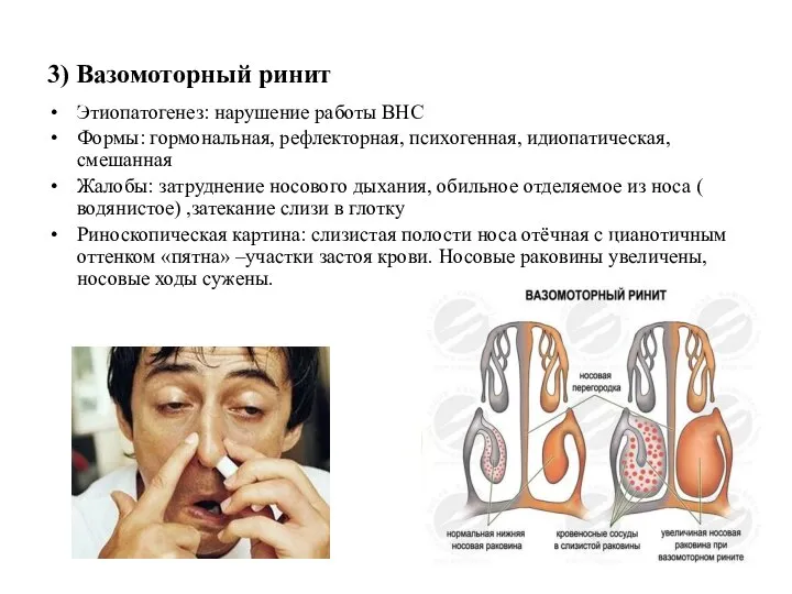 3) Вазомоторный ринит Этиопатогенез: нарушение работы ВНС Формы: гормональная, рефлекторная, психогенная,