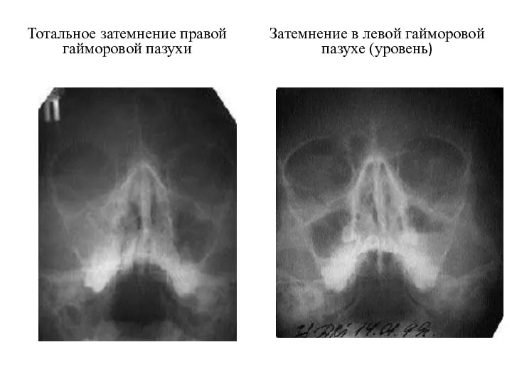 Тотальное затемнение правой гайморовой пазухи Затемнение в левой гайморовой пазухе (уровень)
