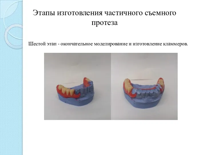 Этапы изготовления частичного съемного протеза Шестой этап - окончательное моделирование и изготовление кламмеров.